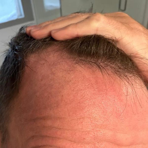 Before image, top of man's scalp is visible due to balding.