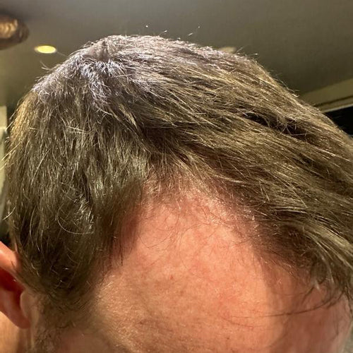After image, top of man's scalp showing signs of hair regrowth.