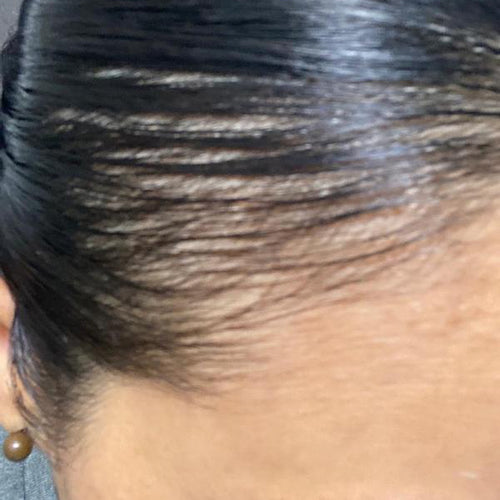Before image, top of woman's scalp is visible due to balding.