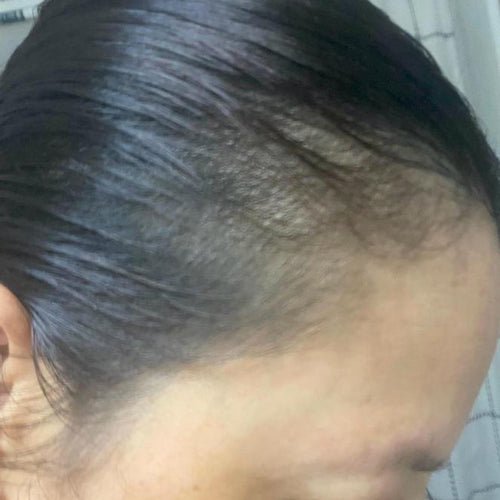 After image, top of woman's scalp showing signs of hair regrowth.