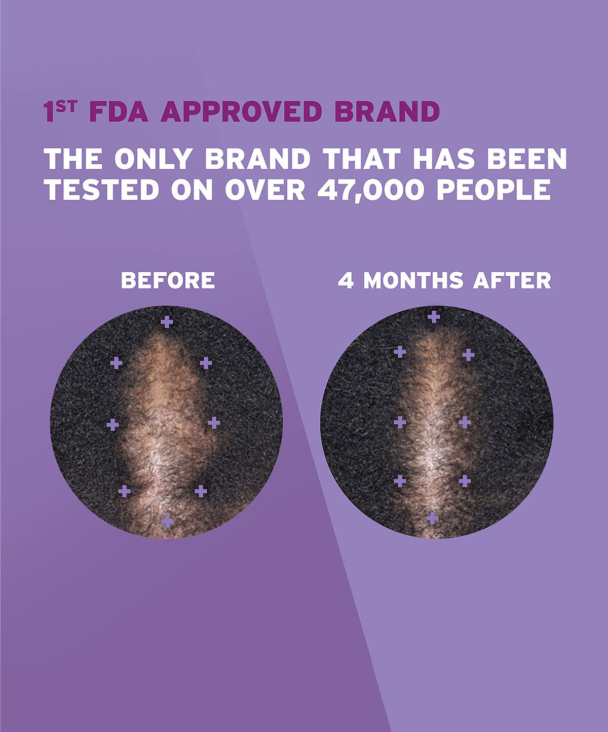 A before and after picture of a woman with dark brown hair showing hair regrowth.