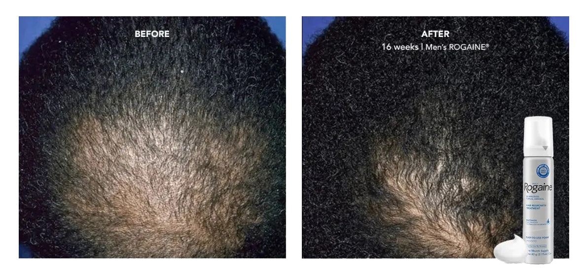 How ROGAINE® Works to Regrow Fuller Hair ROGAINE®