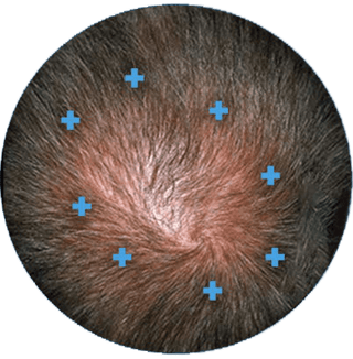 After image, top of man's scalp showing signs of hair regrowth.