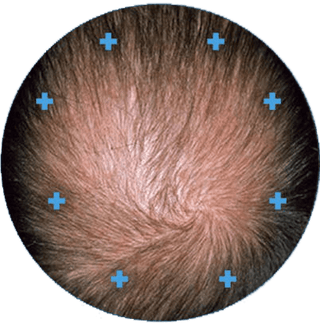 Before image, top of man's scalp is visible due to balding. 