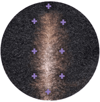 After image, top of woman's scalp showing signs of hair regrowth.