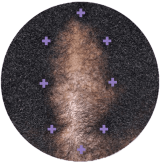 Before image, top of woman's scalp is visible due to balding.