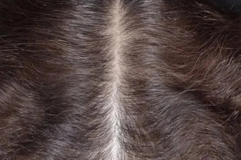 Rogaine testimonial after