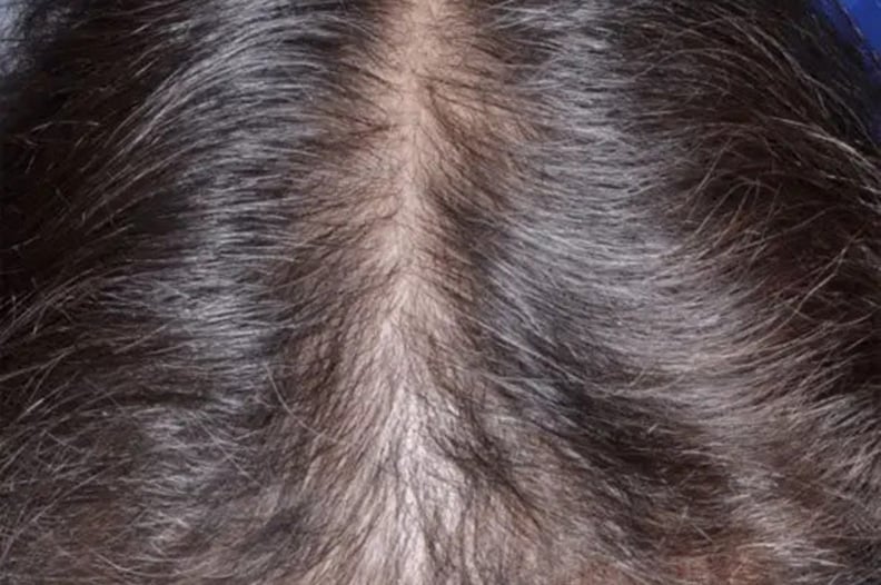 Rogaine testimonial before